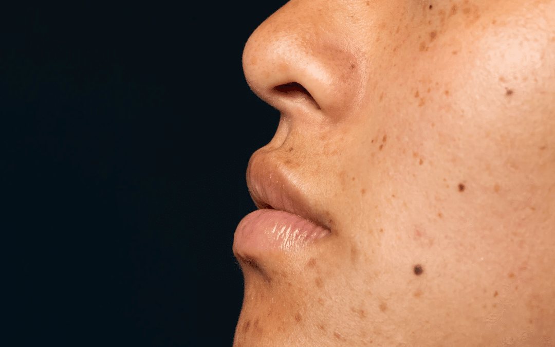 Understanding Brown Spots and Hyperpigmentation